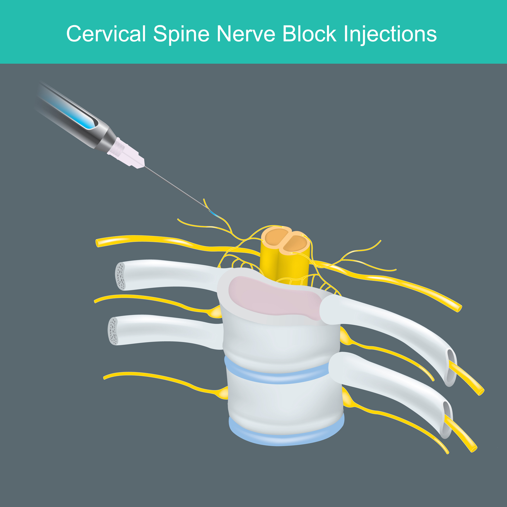 SpineArt surgery process for Nerve Root Block Injections