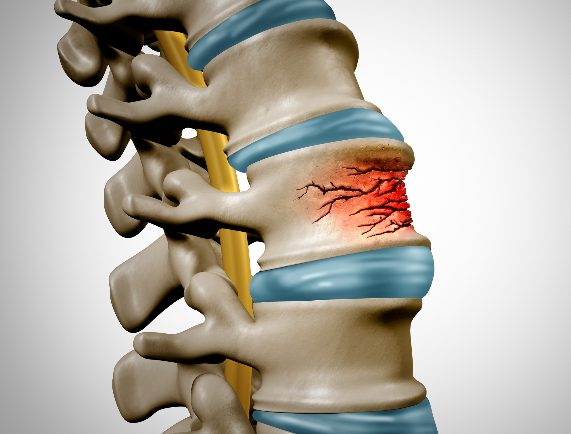 Understanding the Types of Spinal Fractures: A Guide to Back Injuries